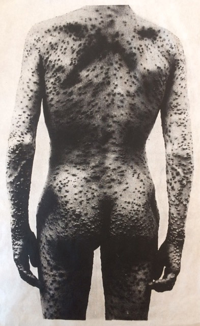 small pox source image